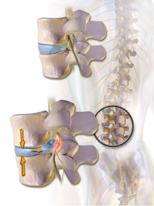 disc herniation massage therapy
