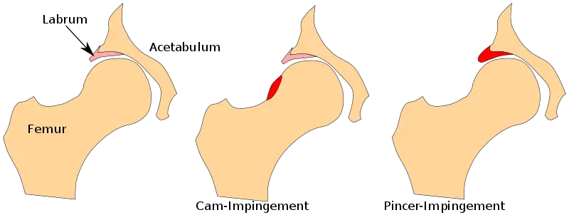 types femoroacetabular impingement