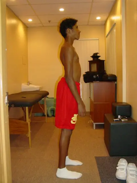 young man with excessive lordosis and anterior pelvic tilt