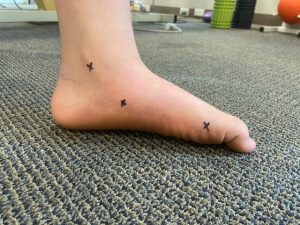 foot pronation flat foot man