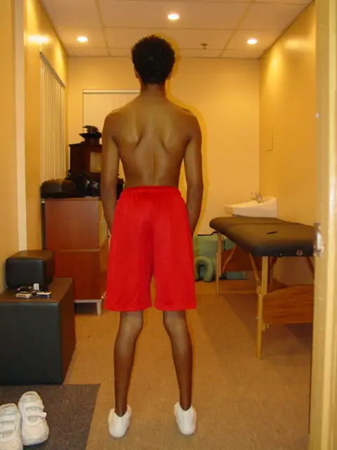 young man scoliosis