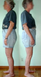 woman with posterior pelvic tilt