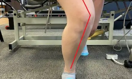 Does Q Angle Affect Knee and Hip Pain?