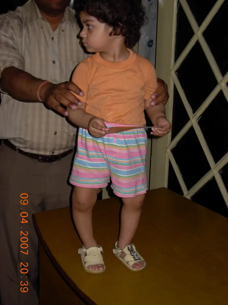 Child with Knee Varus and Rickets