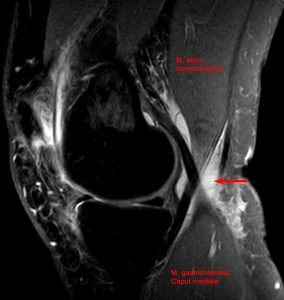 MRI of baker's cyst