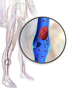 deep vein thrombosis pain behind knee