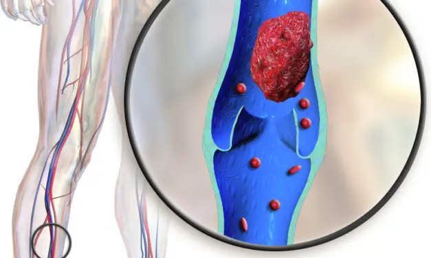 Should You Get a Massage for Deep Vein Thrombosis?