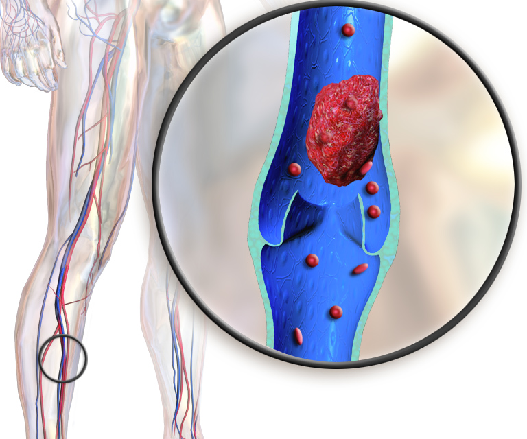 Should You Get a Massage for Deep Vein Thrombosis?