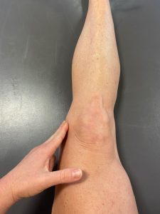 pes anserine bursitis knee pain