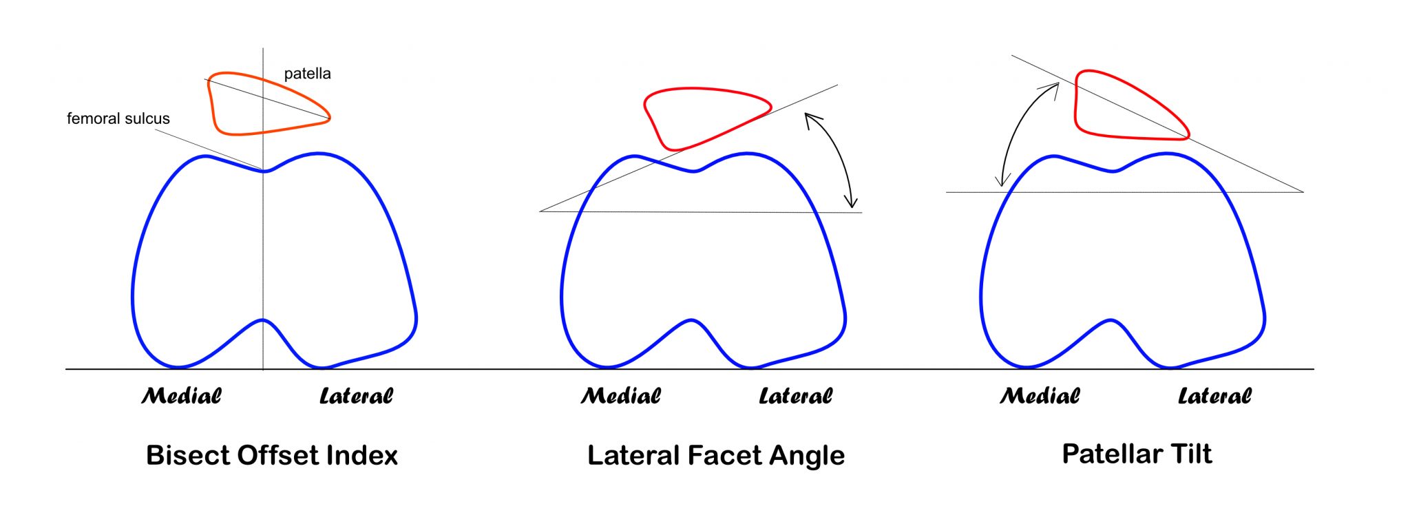 Does Patellar Tracking Disorder Cause Knee Pain? - Massage & Fitness ...