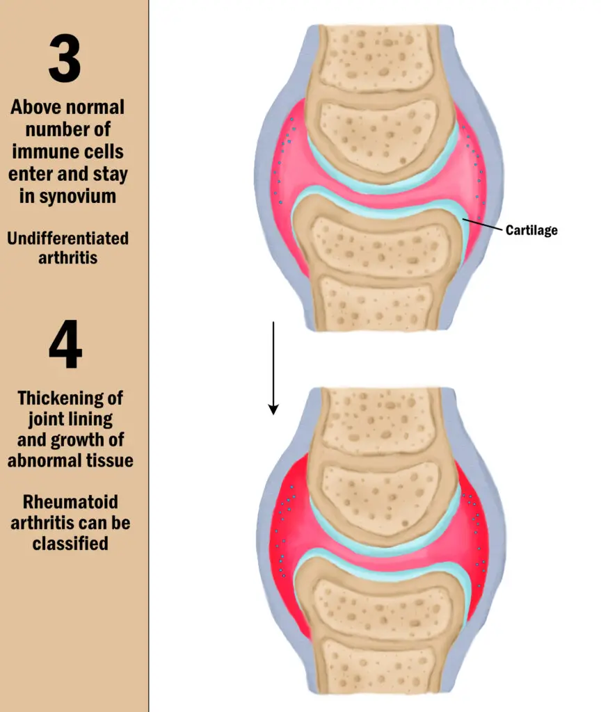 Illustration of a generic joint at late stages of rheumatoid arthritis.