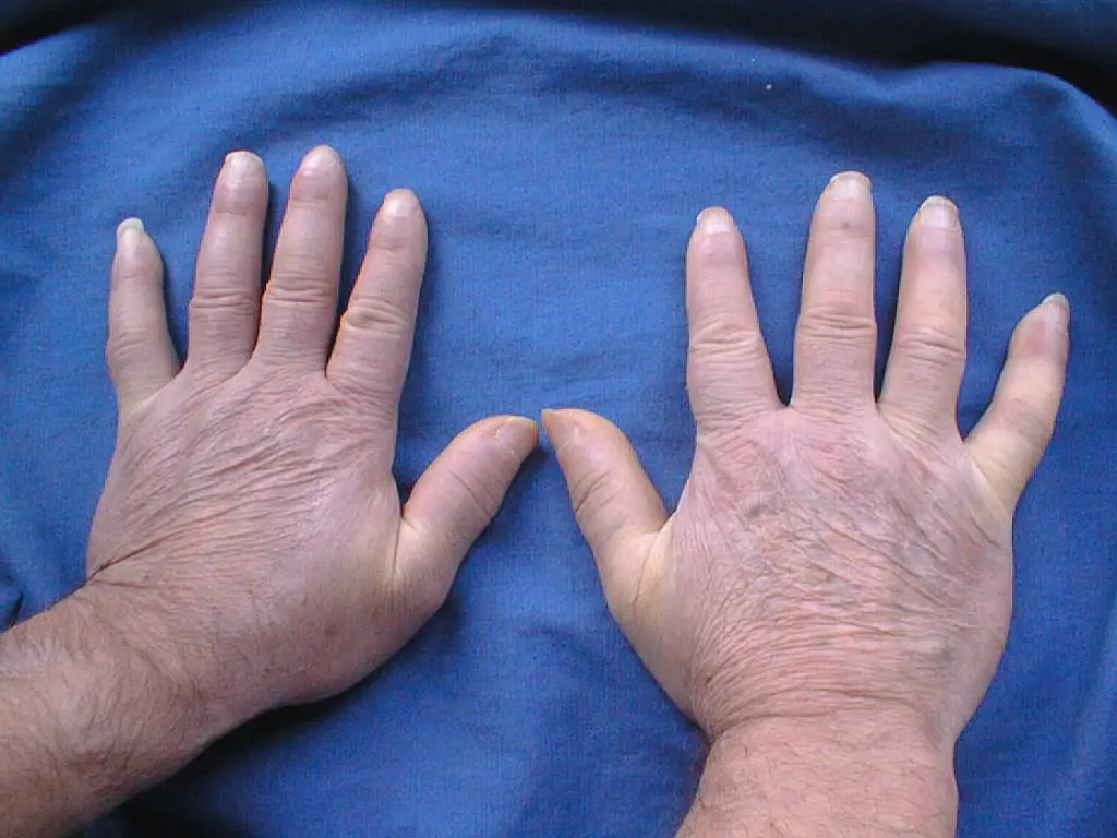scleroderma hands