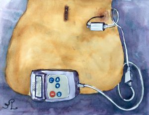 CRPS advocate Kris Leong's spinal cord stimulation implant (SCS). (Image courtesy of Kris Leong)