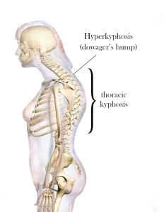 dowager's hump thoracic hyperkyphosis