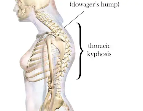 Can Exercise Fix a Dowager’s Hump?