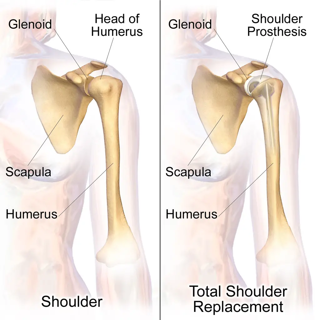 shoulder arthroplasty
