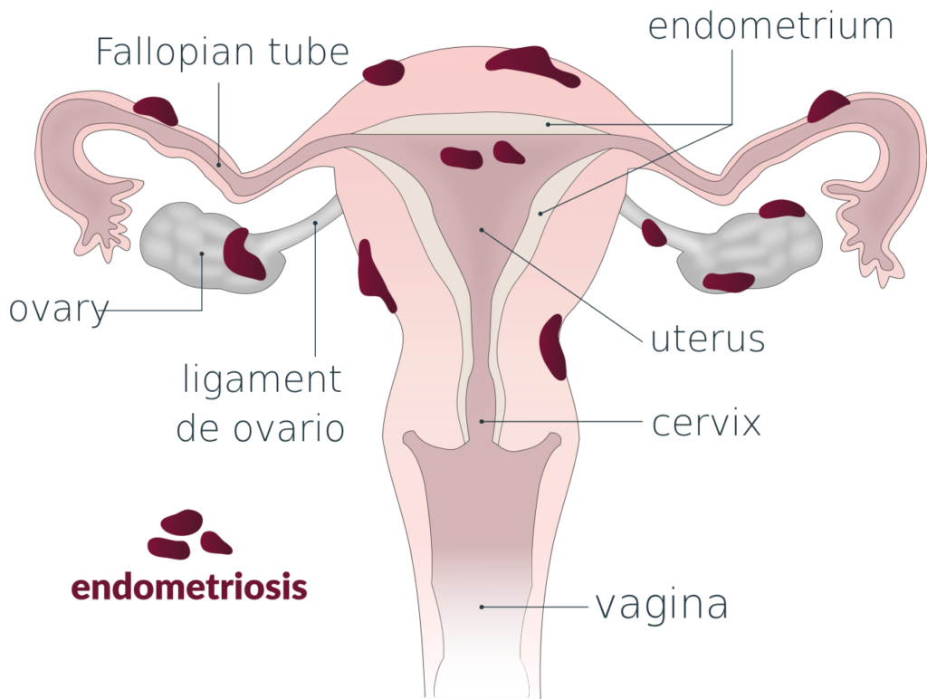 endometriosis in uterus