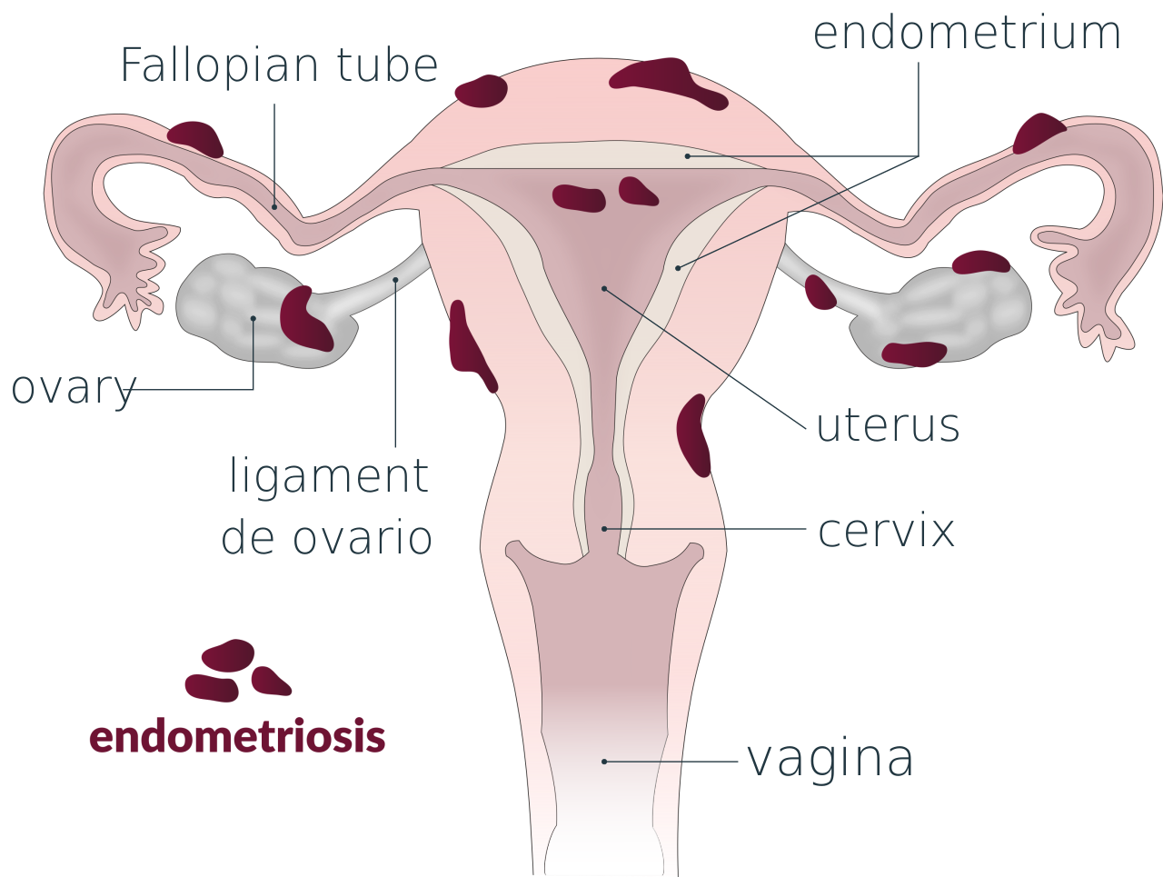 endometriosis in uterus