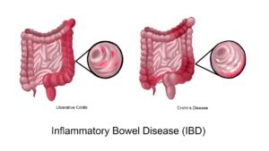 irritable bowel syndrome