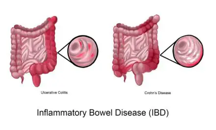 Can Irritable Bowel Syndrome (IBS) Cause Back Pain?