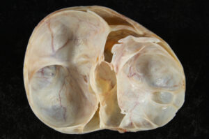 ovarian cyst