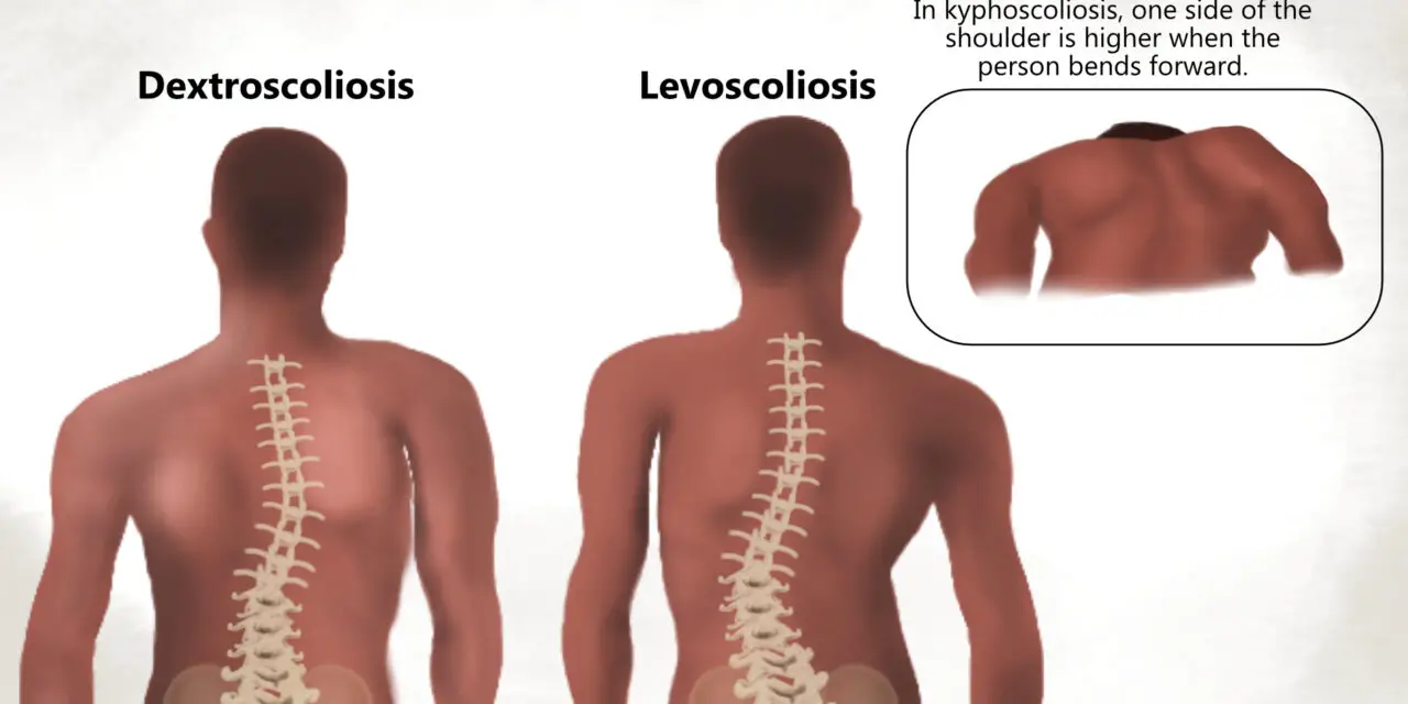 What Is Kyphoscoliosis and Can It Be Treated?