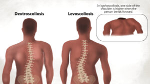 kyphoscoliosis vs scoliosis