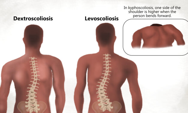 What Is Kyphoscoliosis and Can It Be Treated?