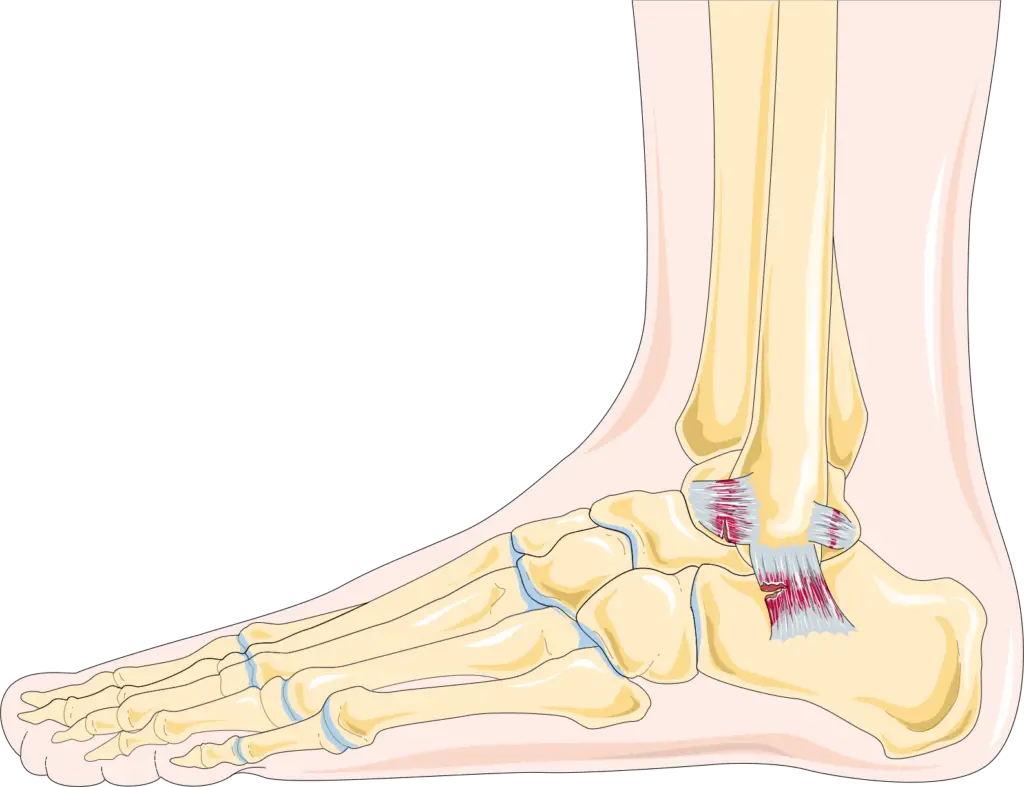 Illustration of ankle ligaments with small tears