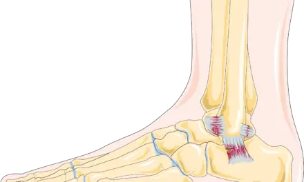 Sprain vs Strain: How to Tell the Difference