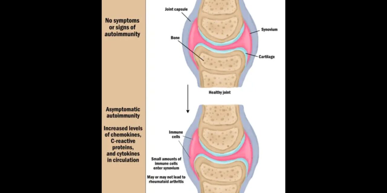 Rheumatoid arthritis (RA): Does massage work?