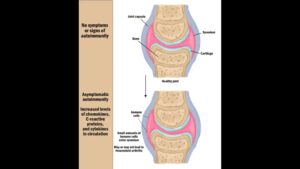 Illustration of a generic joint at stages 1 and 2 of rheumatoid arthritis.
