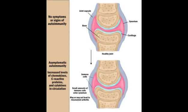 Rheumatoid arthritis (RA): Does massage work?