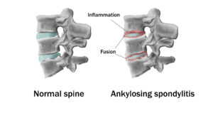 Illustration of “bamboo” spine of ankylosing spondylitis.