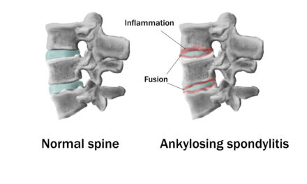 Massage therapy for ankylosing spondylitis: What science says and how to find a good therapist