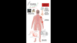 Illustration of biopsychosocial factors that contribute to fibromyalgia.