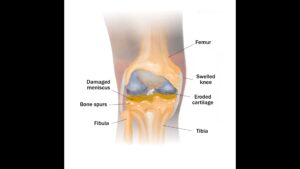 Illustration of a knee with osteoarthritis.
