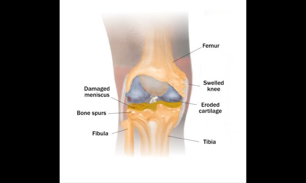 Can massage reduce osteoarthritis joint pain?