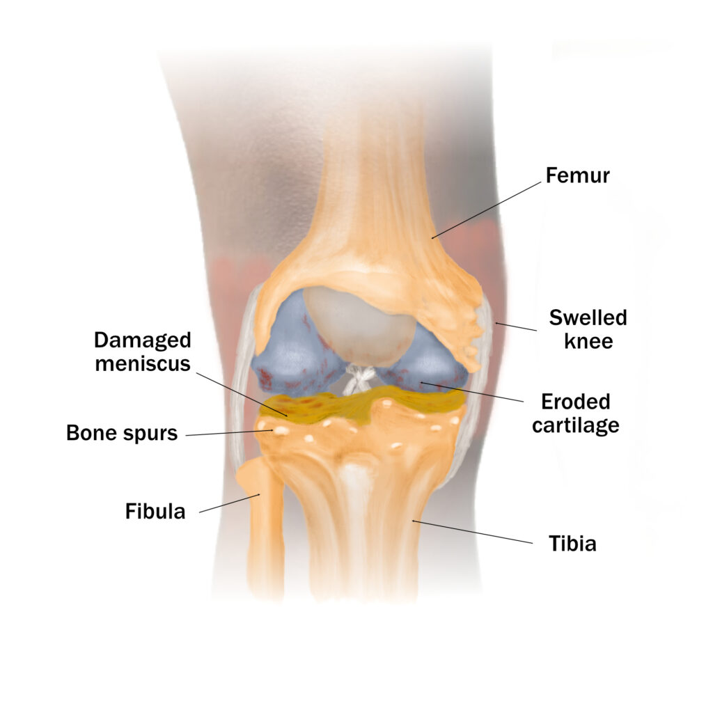 Illustration of a knee with osteoarthritis.