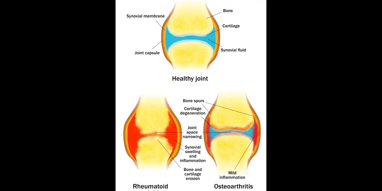 Physical therapy, massage, exercise for arthritis: A review of the scientific evidence