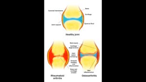 Illustrations of a healthy joint, an osteoarthritis joint, and a rhematoid arthritis joint.