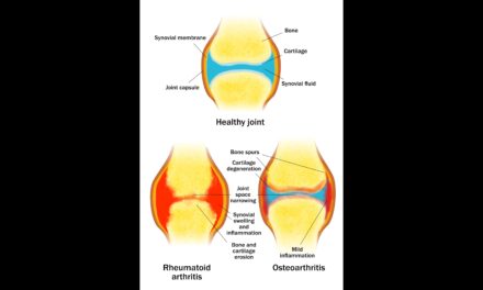 Physical therapy, massage, exercise for arthritis: A review of the scientific evidence