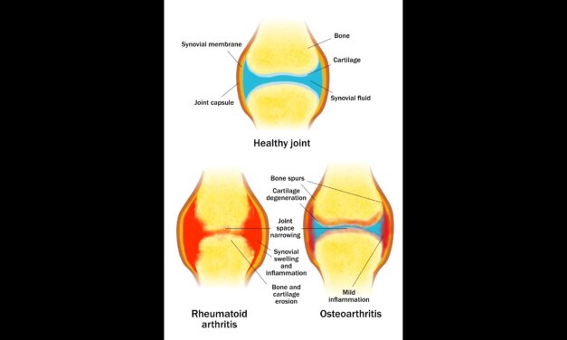 Physical therapy, massage, exercise for arthritis: A review of the scientific evidence